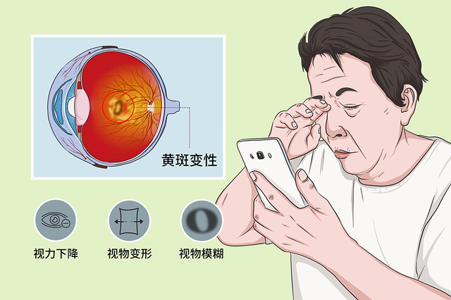 漯河眼底黄斑变性