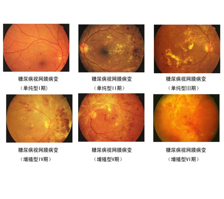 漯河眼底病变