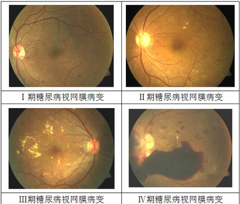 漯河糖尿病眼底病发