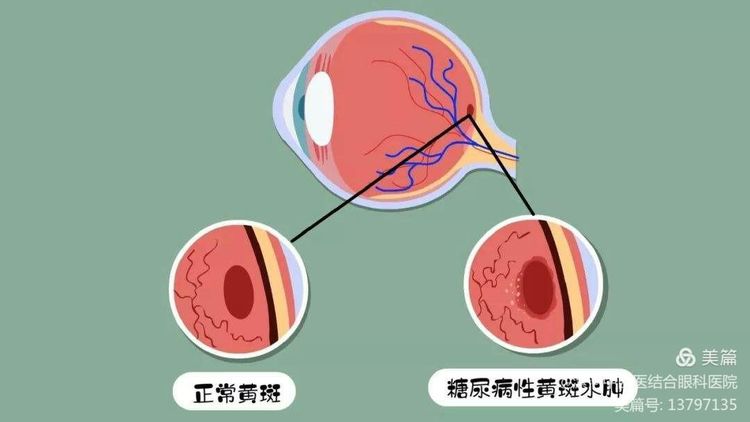 黄斑水肿的中医药**